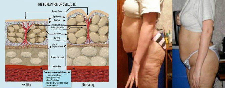 Cellulite Be Gone Together To Success
